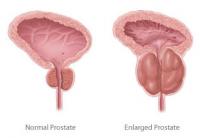 Benign prostatic hypertrophy