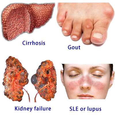lasix effect on liver