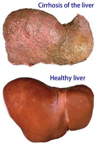 Liver problems