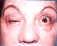 Myasthenia  gravis