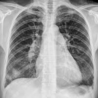 Pulmonary arterial hypertension