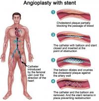 Angioplasty with stent
