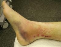 Ankle ulcers