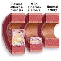 Atherosclerosis