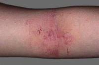 Atopic dermatitis in cubital fossa
