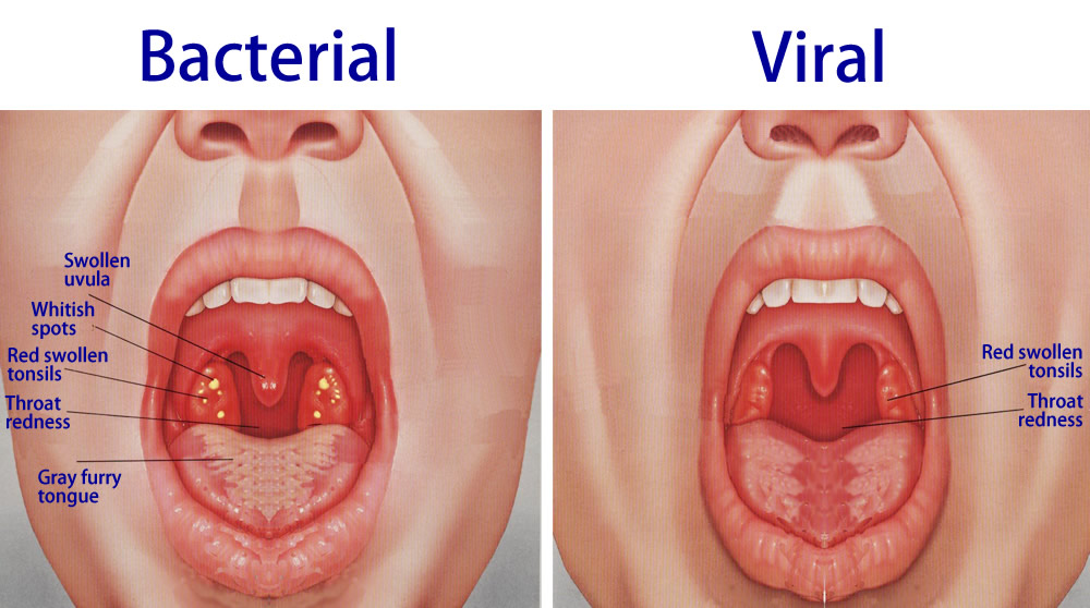 Virus Throat 57