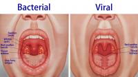 Bacterial and viral tonsillitis