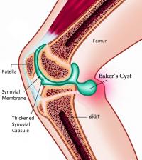 Bakers cyst