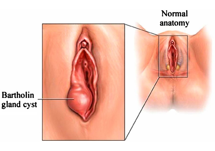 Care of Pimples on Labia Minora - Buddy MD