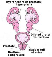 Bilateral hydronephrosis