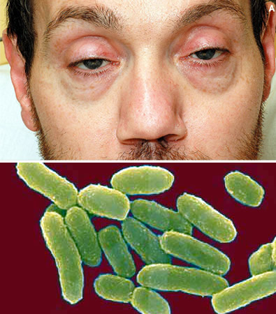 botulism symptoms botulinum clostridium diagnosis poisoning food causes treatment bacteria caused