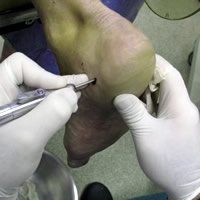 Calcaneal spur treatment