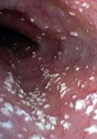 Candidiasis Vaginal