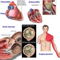 Cardiac diseases