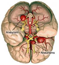 Cerebral aneurysms