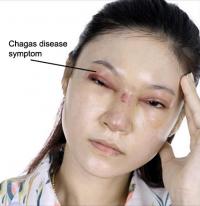 Chagas disease symptom