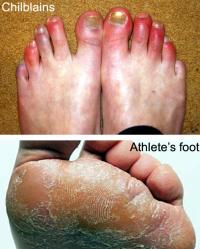 Chilblains and Athlete`s foot