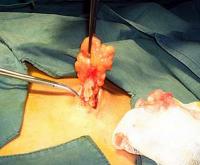 Classic lipoma excision