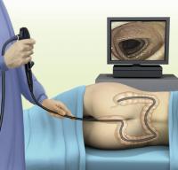 Colonoscopy procedure