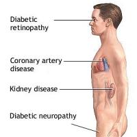 Complications of diabetes