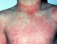 Dengue rash