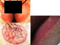 Dermatophytosis (ringworm)