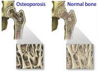 Diagnosis of osteoporosis