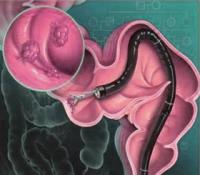 Diagnosis of polyps