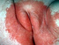 Diaper dermatitis