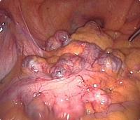 Diverticulitis (colonoscopy)