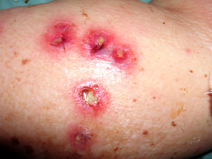 Pictures of Acute Streptococcal Tonsillitis (Strep Throat ...
