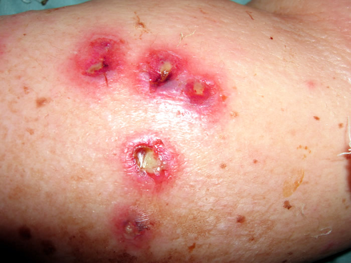 ecthyma impetigo