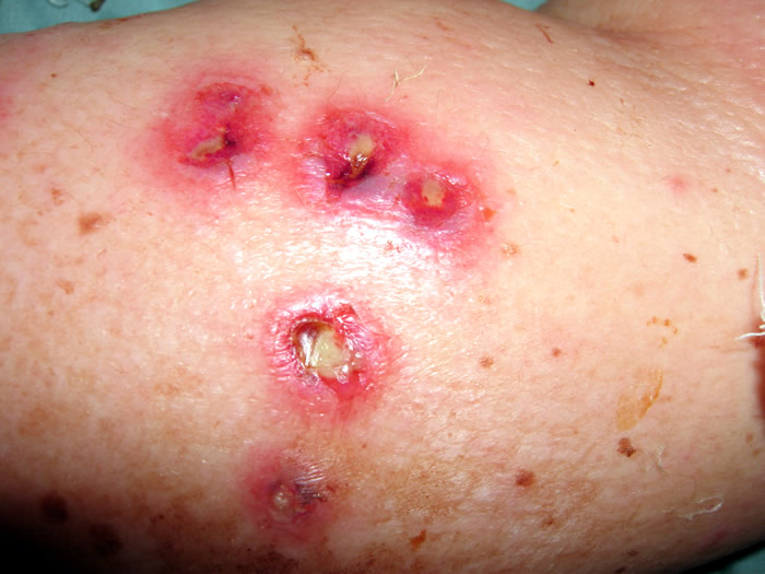 ecthyma impetigo