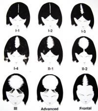 Female patterns of hair loss