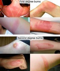First and second degree burns