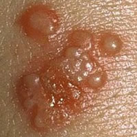 genital herpes images