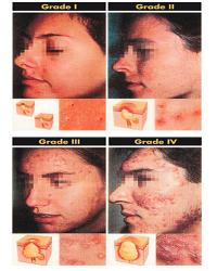 Grades of acne