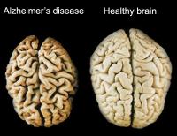 Healthy and affected brain