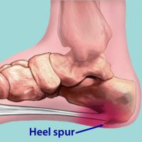 Heel spur