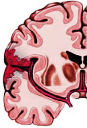 Hemorrhagic stroke