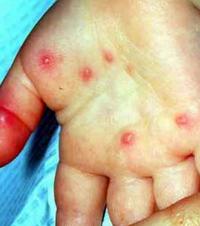 Hepatitis A symptoms