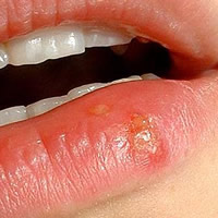 Herpes recurrences