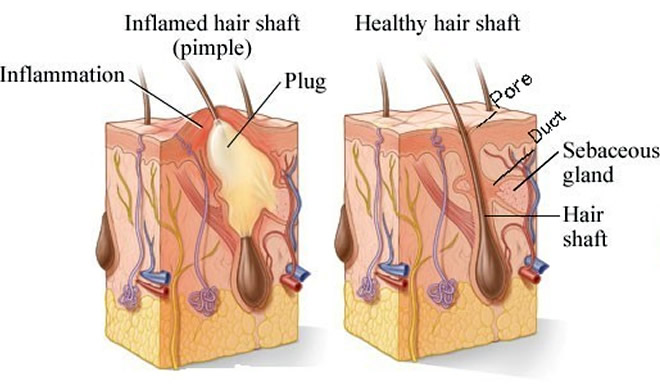 Inflamed hair shaft 
