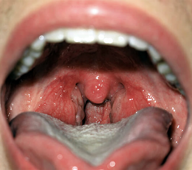 Red Swollen Throat 68