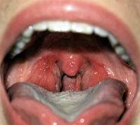 Inflamed sore throat