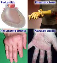 Inflammatory diseases