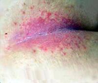 Intertrigo (candidiasis skin)