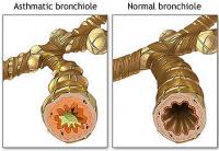 Intrinsic asthma