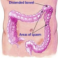 Irritable bowel syndrome