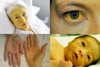 Jaundice symptoms